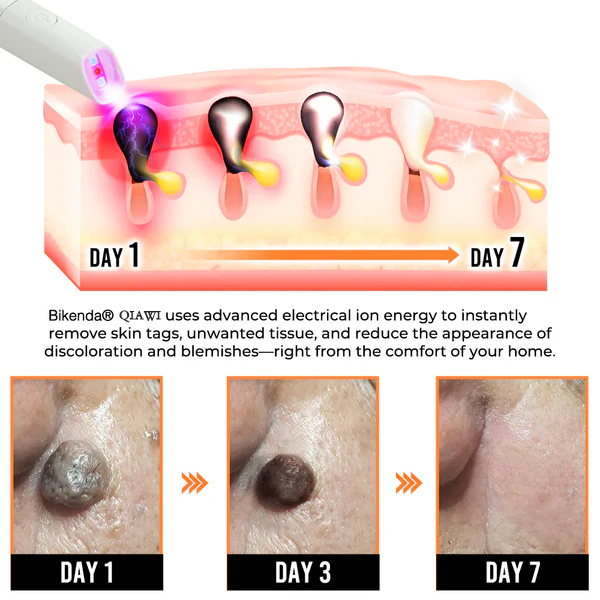 QIAWI™ All-in-One CO₂ Laser Eraser Pen | Removes Moles, Warts, Skin 17 17591364566547
