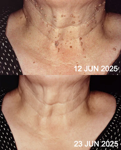 QIAWI™ All-in-One CO₂ Laser Eraser Pen image QIAWI™ All-in-One CO₂ Laser Eraser Pen