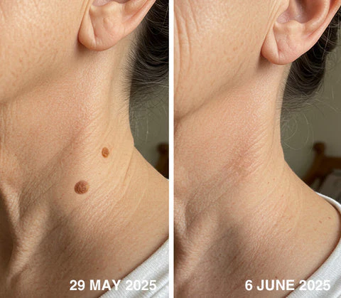 QIAWI™ All-in-One CO₂ Laser Eraser Pen image QIAWI™ All-in-One CO₂ Laser Eraser Pen